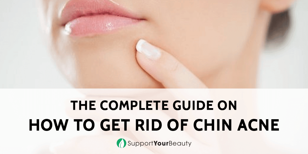 How To Get Rid Of Chin-Acne