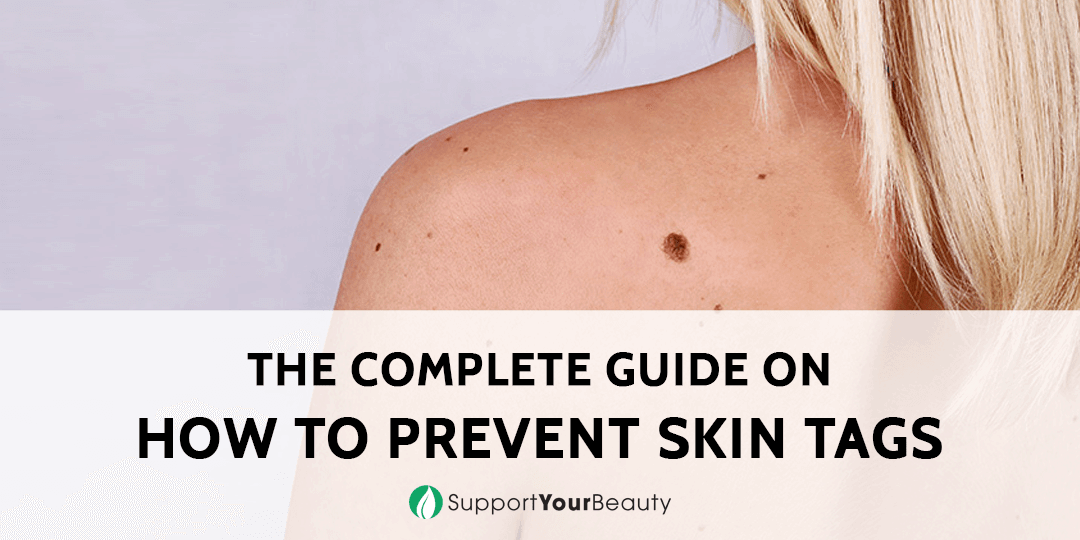 How To Prevent Skin Tags