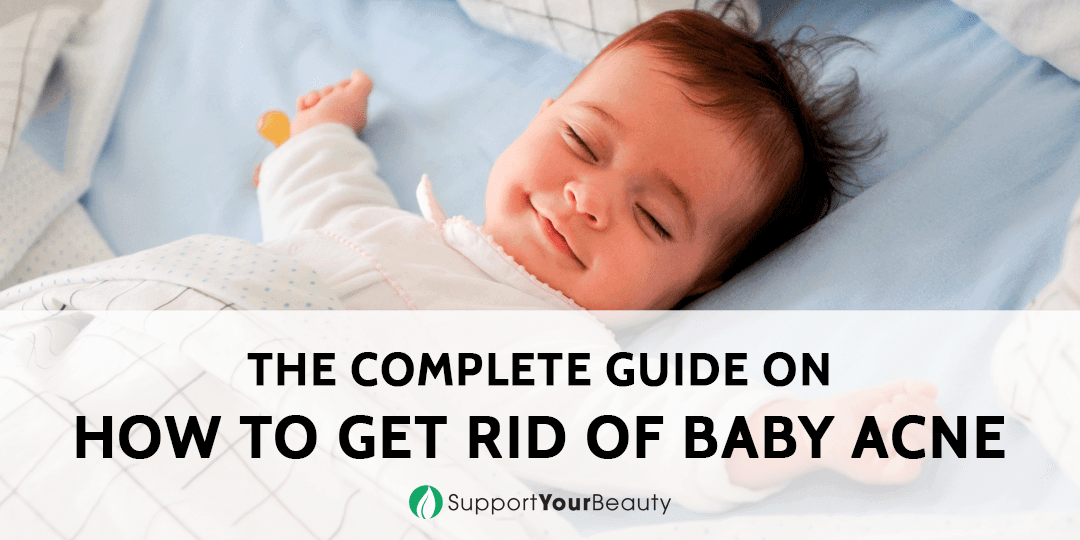 How To Get Rid Of Baby Acne