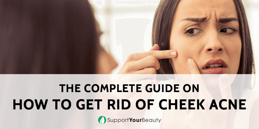 How To Get Rid Of Cheek Acne