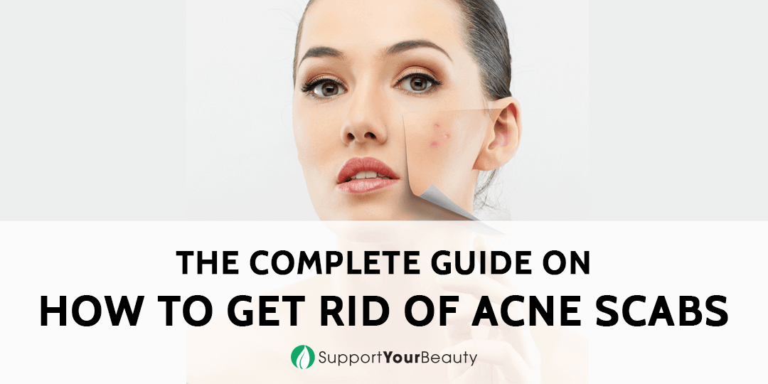 How to Get Rid of Acne Scabs