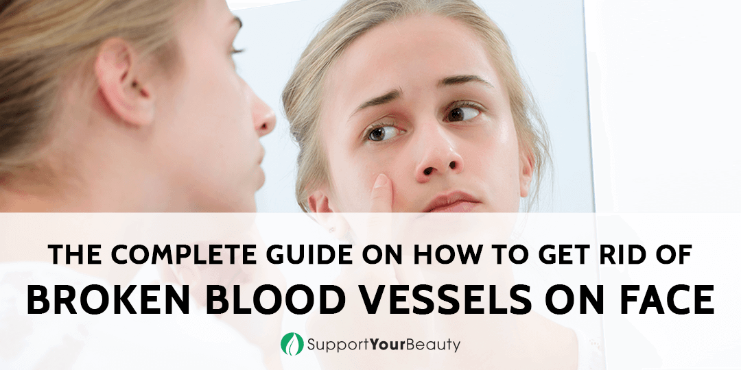 how-to-get-rid-of-broken-blood-vessels-on-face-updated-2023