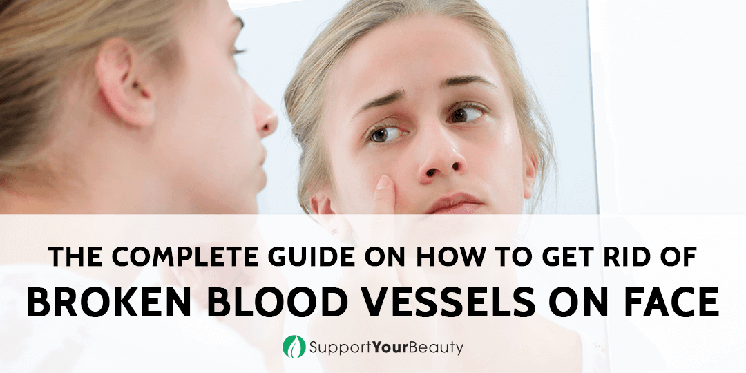 How To Get Rid Of Broken Blood Vessels On Face